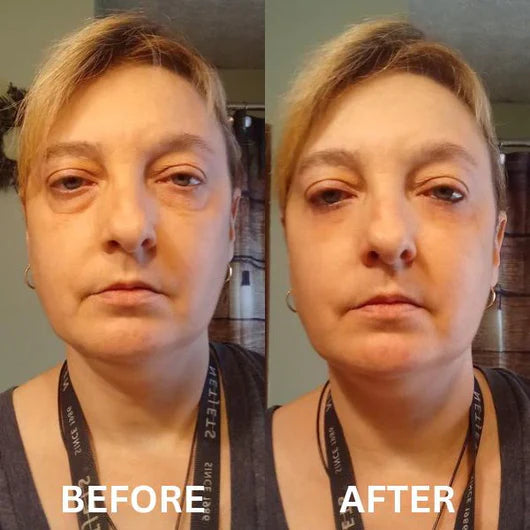 Collagen Infusion Tightening Eye LiftPatches™